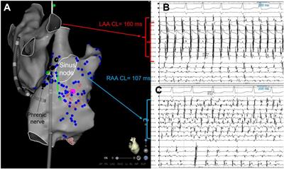 Right atrial appendage firing in atrial fibrillation